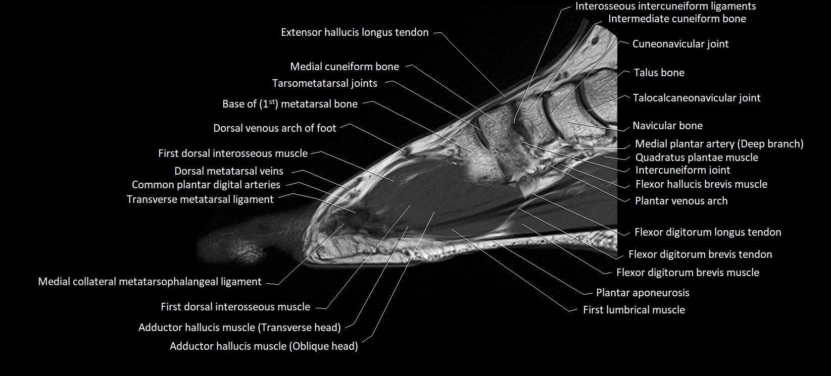 MRI foot sagittal labelled cross sectional anatomy image  10.webp